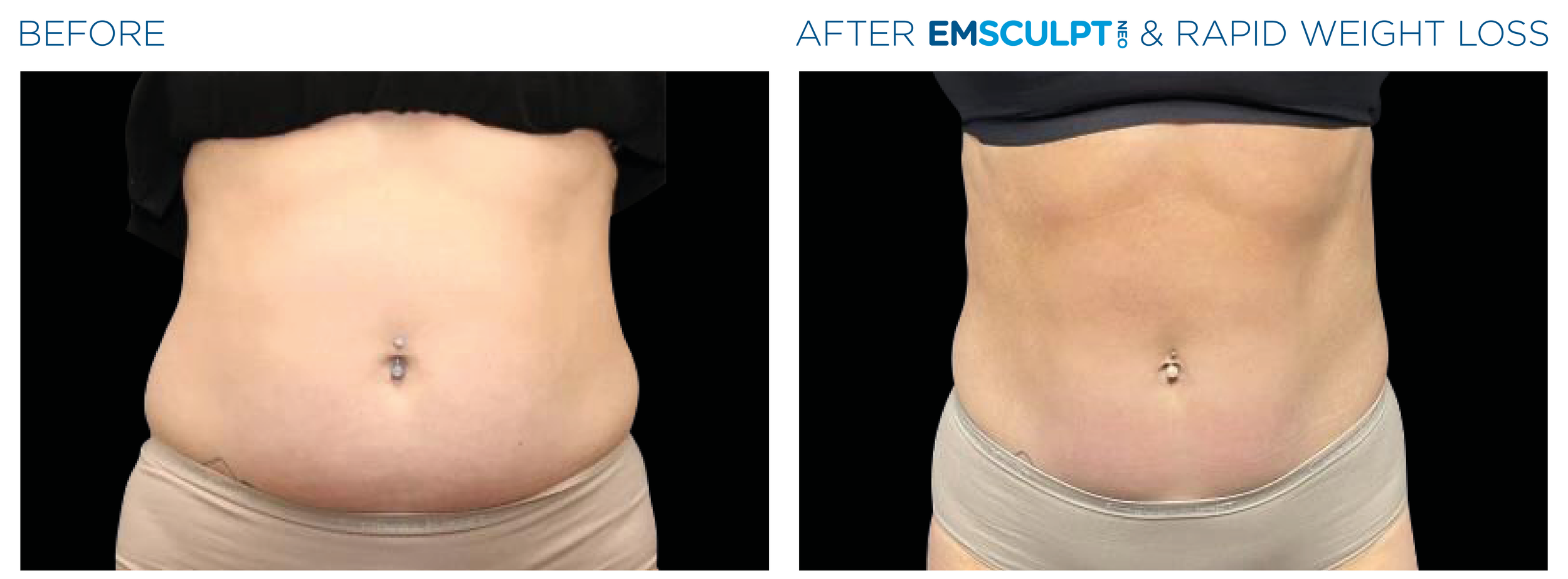 Transform Your Body with EMSCULPT NEO at Liberty Wellness in Raleigh, NC