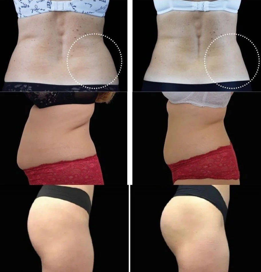 Progress photos showing a woman's abdomen and lower body before and after weight loss, including side and back views, with notable reduction in body fat.