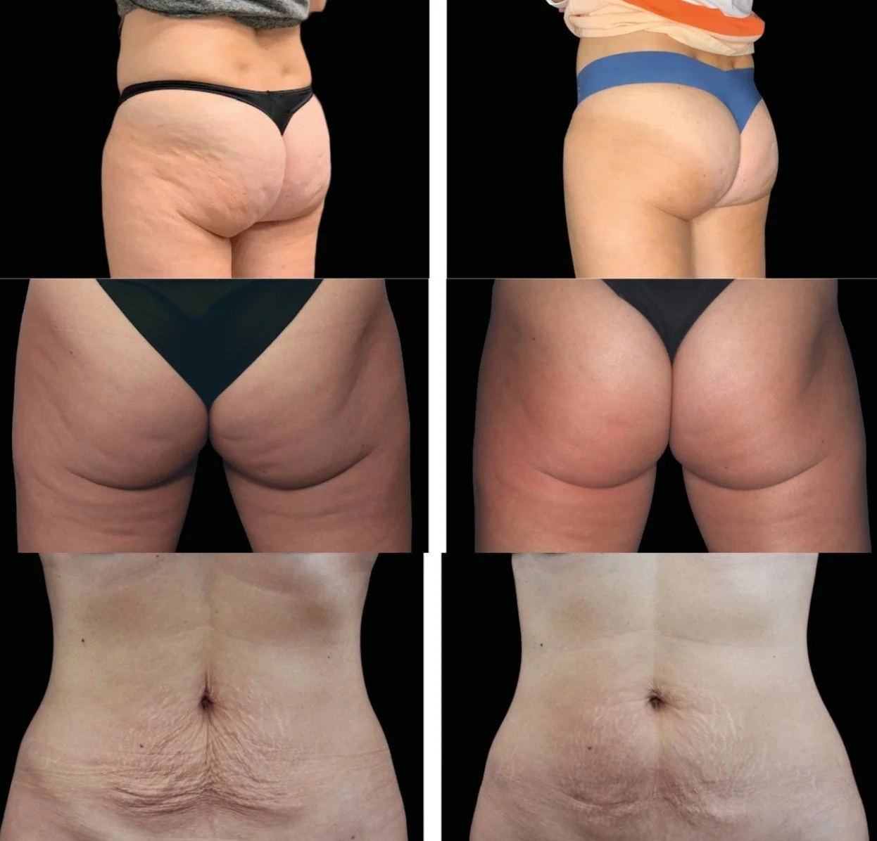 Comparison of before and after images showing skin tightening and cellulite reduction on the buttocks, thighs, and abdomen of a woman.