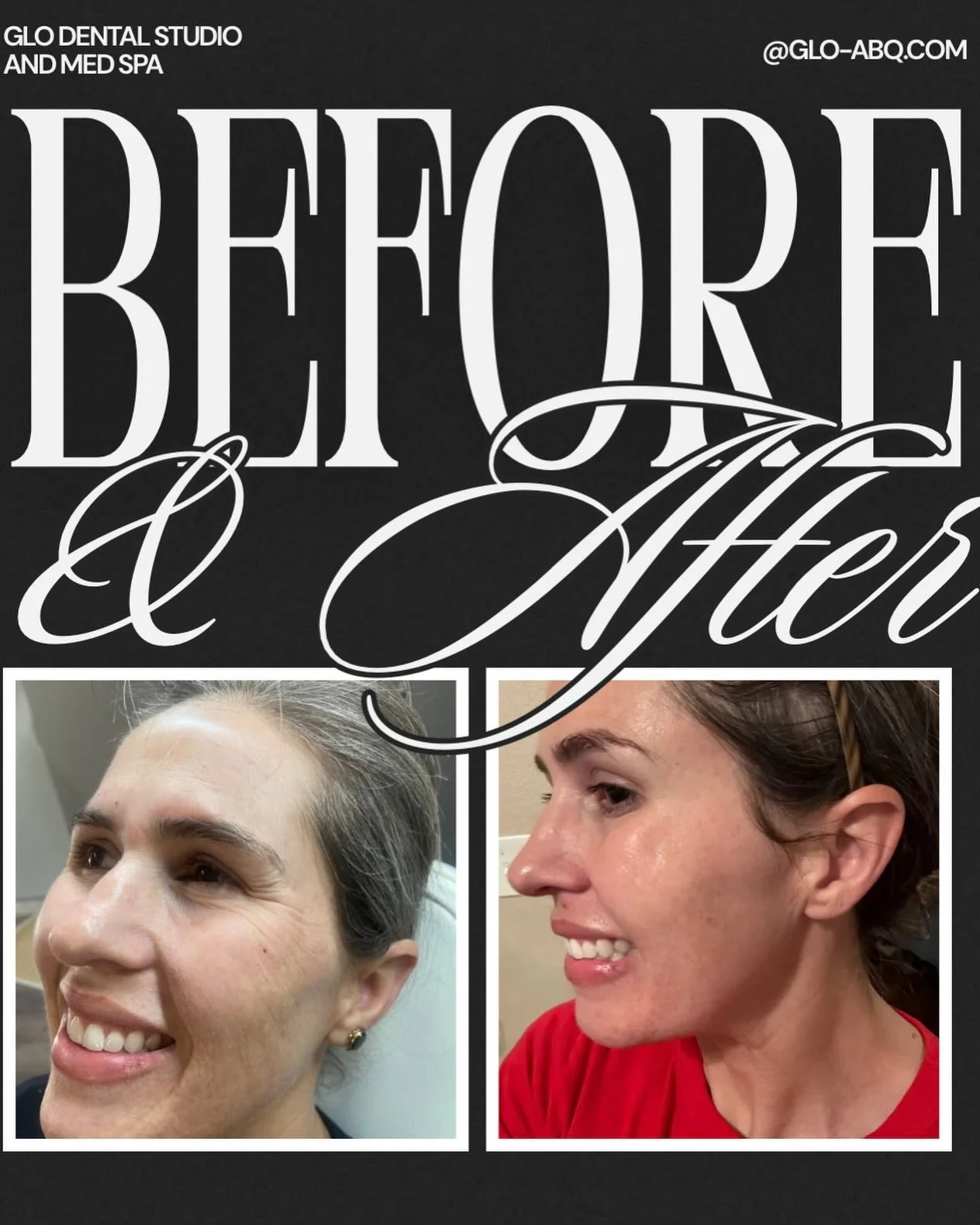 ✨ 2 Weeks Post-Jeuveau ✨

Soft. Smooth. Still you, just refreshed.

This is what Jeuveau looks like at the sweet spot:
✔️ Relaxed expression
✔️ Smoother lines
✔️ Natural movement (no frozen faces here, unless you want 😉)

Jeuveau is our go-to for pa