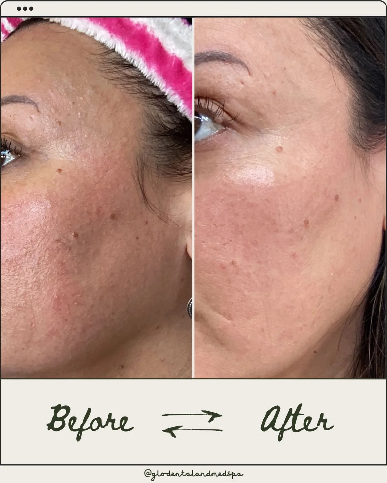 You guys! This is just after 1 Microneedling session with @skinpen (without PRP) and 6 weeks of using only PCA skin sensitive skin regimen. The redness and texture in the first pic 😣 🙈 I&rsquo;m so excited for this skin journey, more to come! ❤️ DM