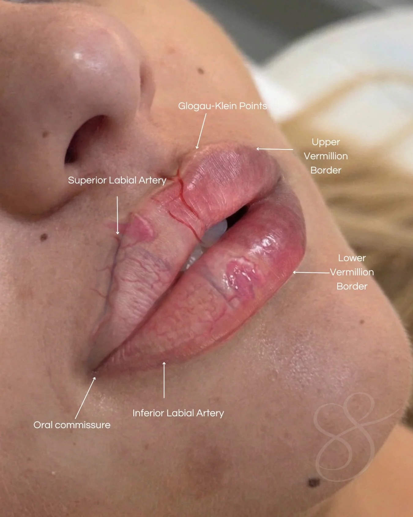 Your lips are so much more than what you see on the surface.⁠
⁠
Lips are made up of muscle, arteries and nerves, which is why they move, feel and look the way they do. Every person&rsquo;s anatomy is different and that&rsquo;s what makes each patient