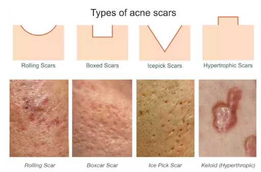 Illustration of four types of acne scars at the top: rolling scars, box-shaped scars, icepick scars, and hypertrophic scars, followed by real-life images showing each type of scar.