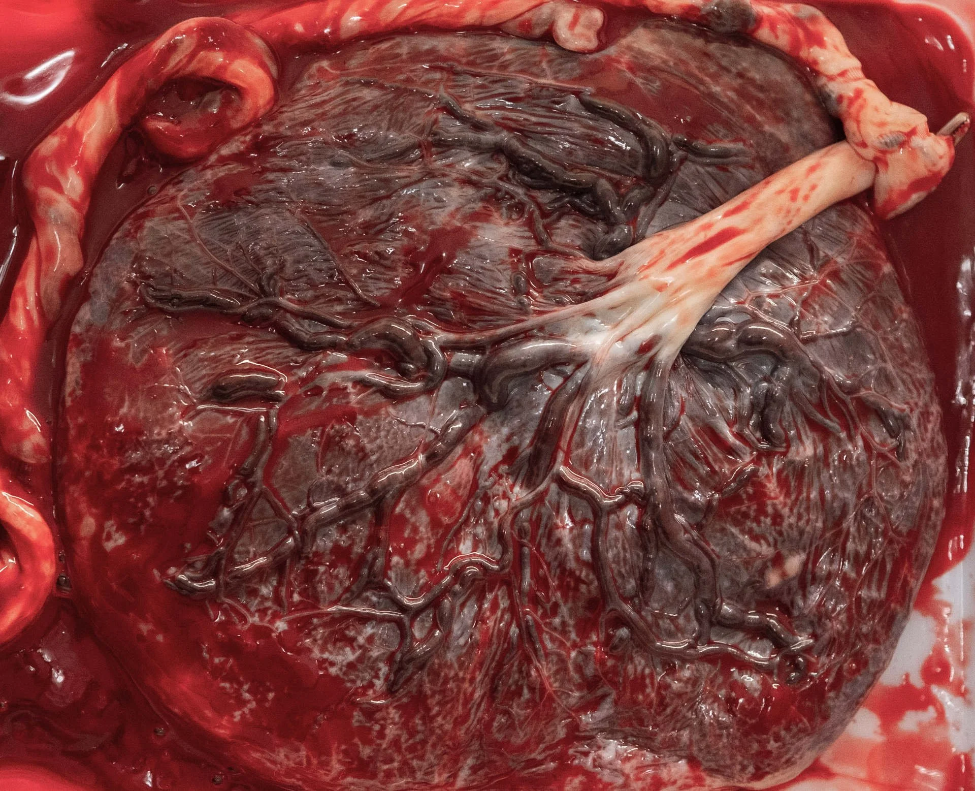 A human placenta with umbilical cord and blood vessels.