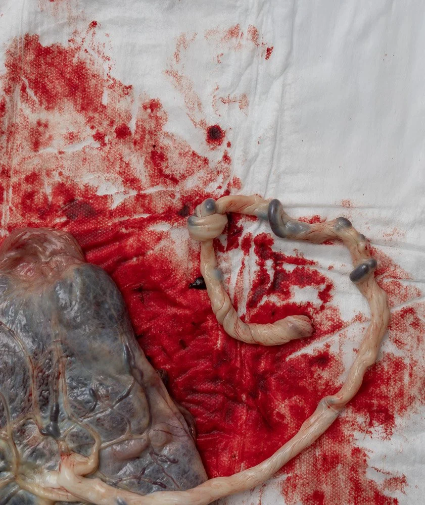a woman's placenta is laying on a chucks pad and there is a true knot in the umbilical cord 