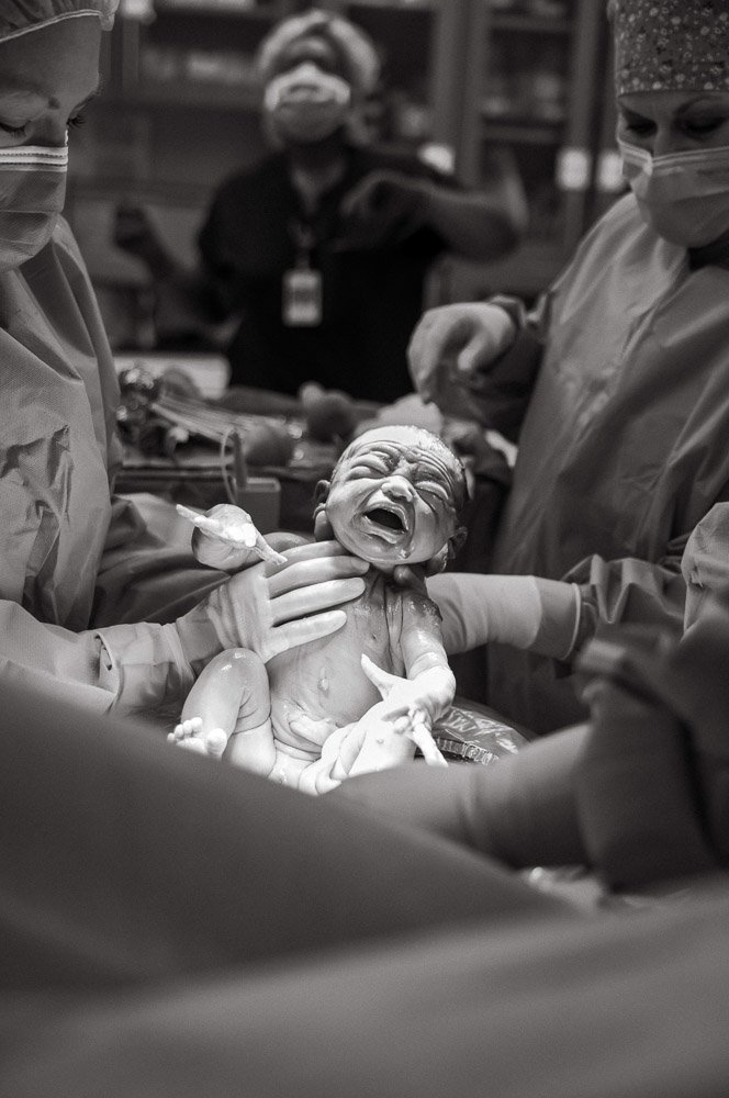 A newborn baby crying during a C-section birth in an operating room with medical staff assisting.