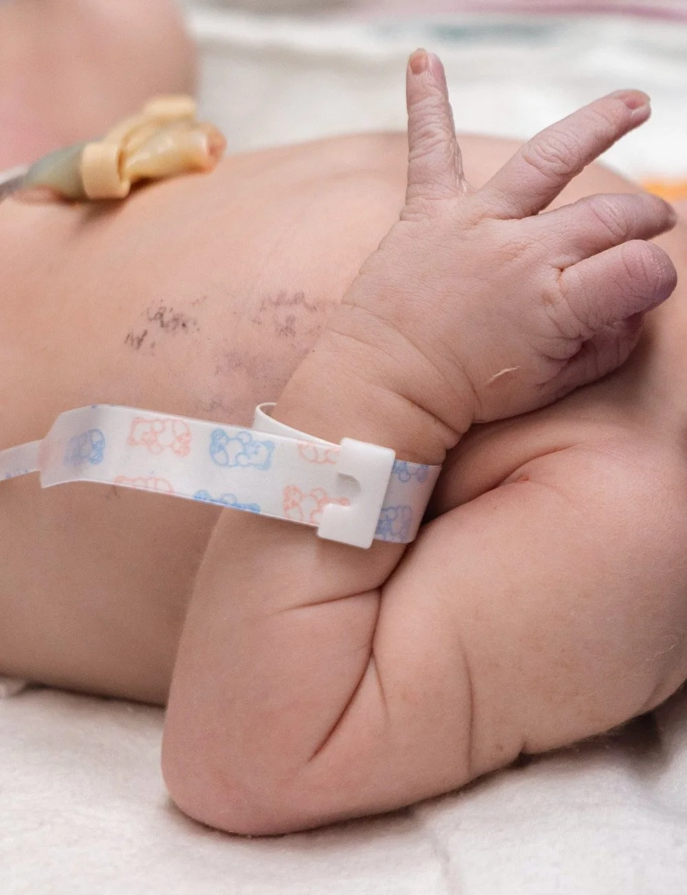 Close-up of a premature baby's hand making a peace sign with their fingers, attached to an IV line, with hospital wristband on the wrist, and a faint scar on the arm.
