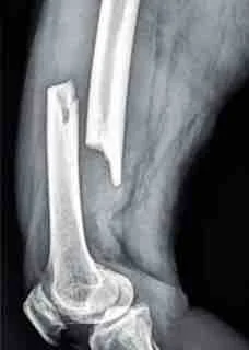 Los Angeles Personal Injury Catastrophic Injury