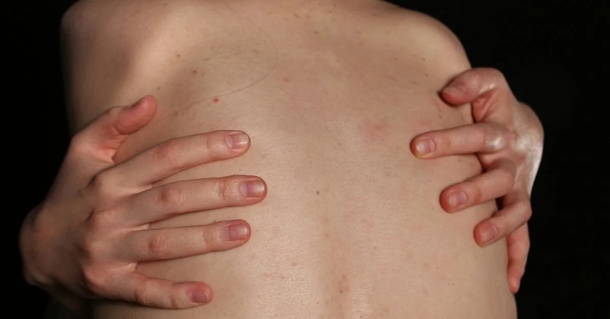 Close up of a person's back with rash. Hands visible on each side as if holding in discomfort