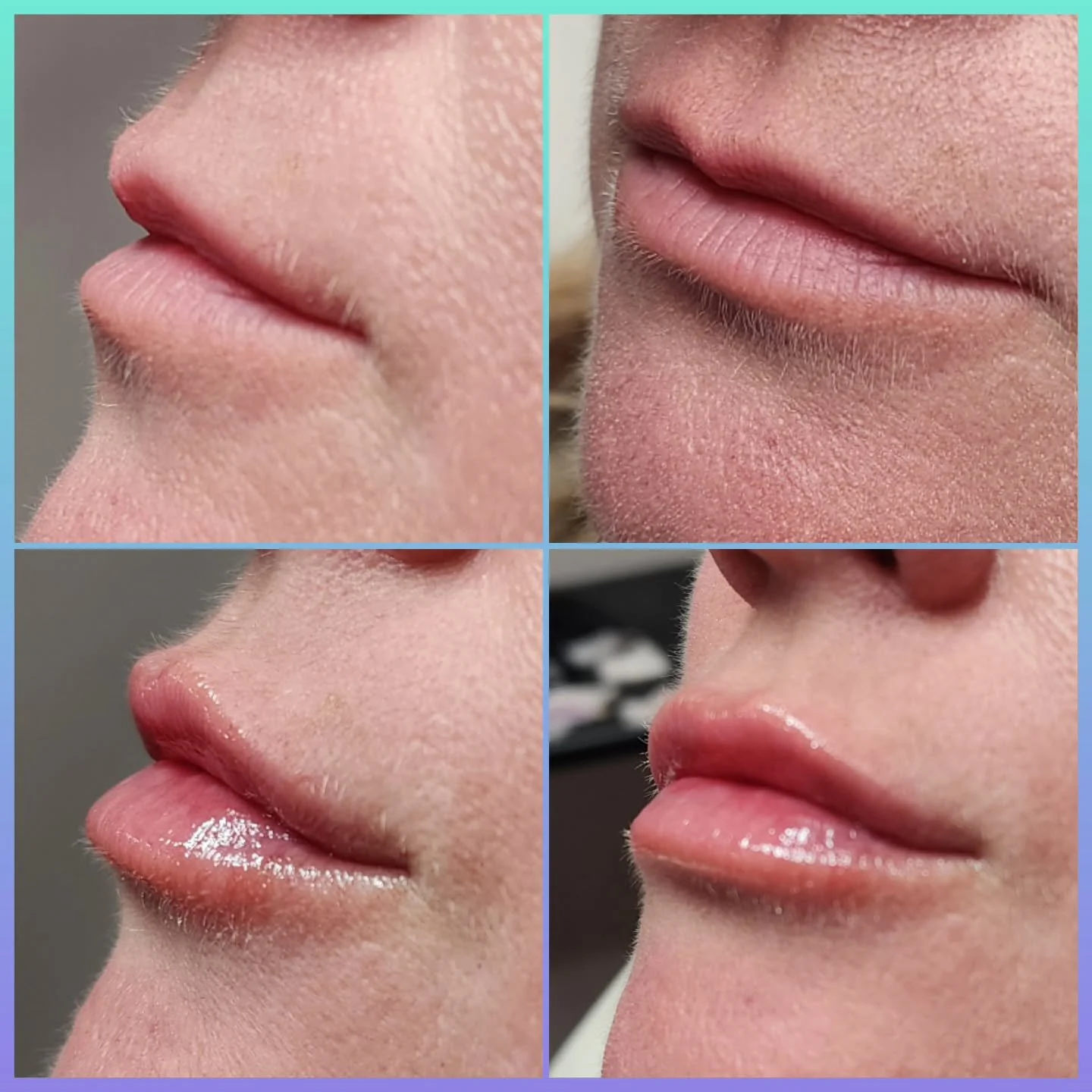 Subtle. Refined. Balanced. ✨

At Refinery by Ashley, lip augmentation is designed with a soft, artistic touch while enhancing your natural beauty with gentle volume, balanced proportions, and a smooth, sophisticated finish.

Transformation doesn&rsqu