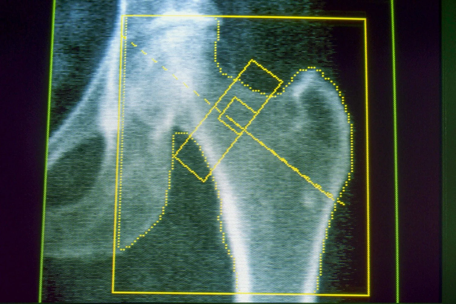 GLP-1 Receptor Agonists and Bone Health