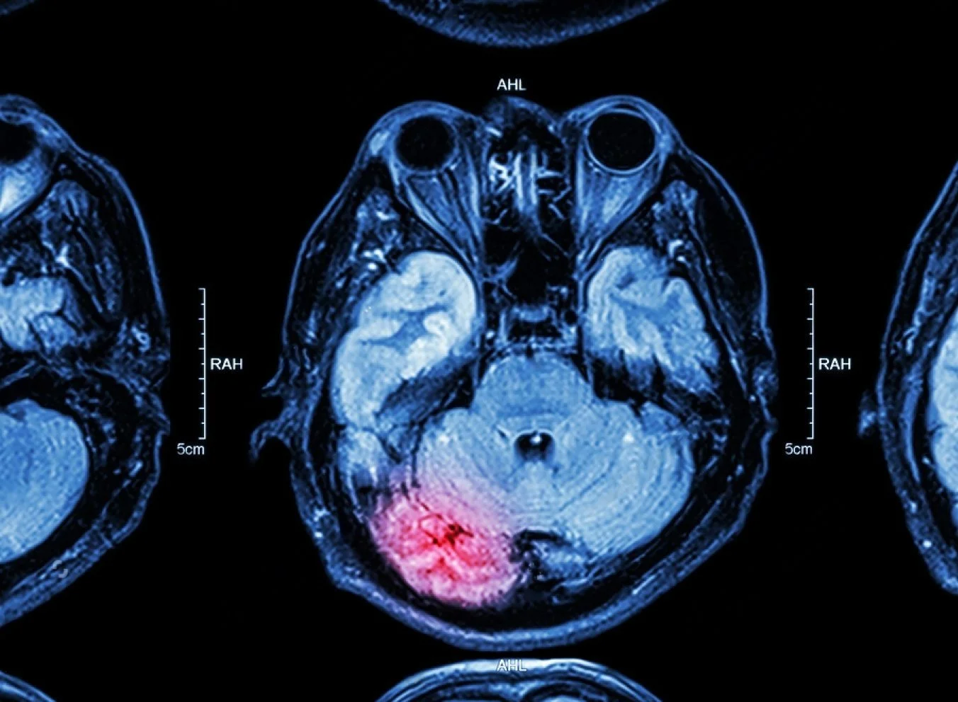 Occupational Therapy management of neurological clients