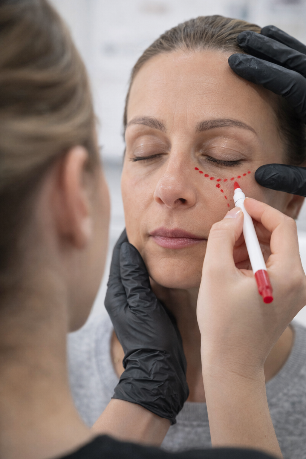 A woman with her eyes closed is having a cosmetic procedure, with a second woman drawing dotted lines on her face near her cheek with a red marker. The second woman is wearing black gloves and is partially visible.