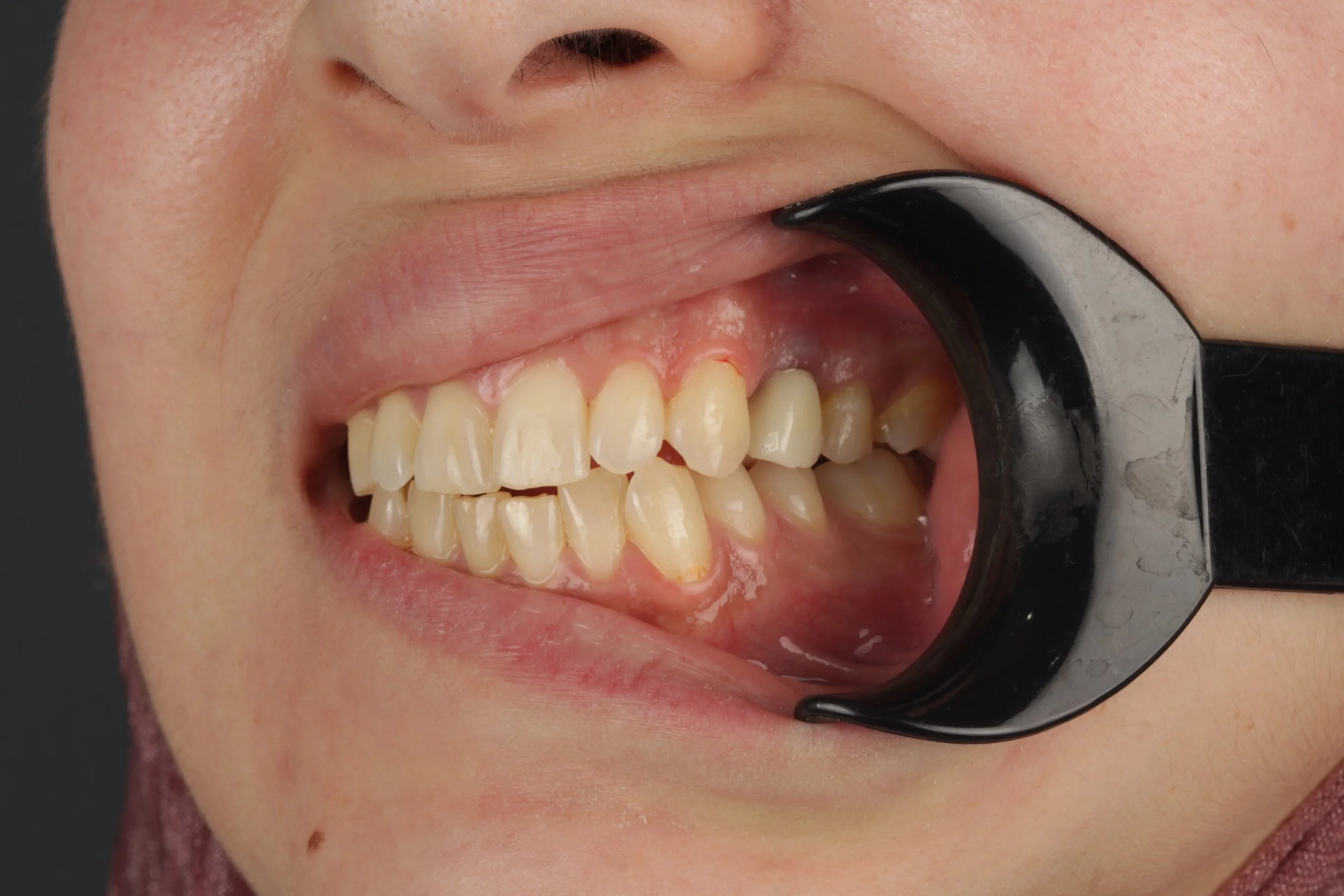 Restore your lost tooth 