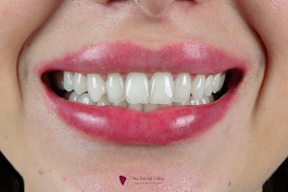 Teeth cleaning & whiting