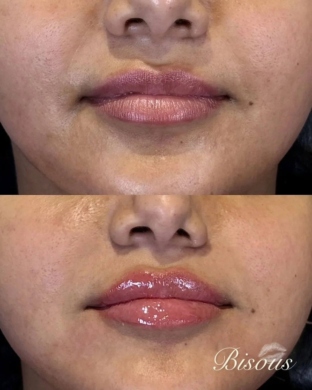 Subtle &amp; symmetrical 💋 

They don&rsquo;t call me the lip queen for nothing🤭🫶🏻

#lipfiller #naturallipfiller #ottawalipfiller #ottawainjections #naturalresults