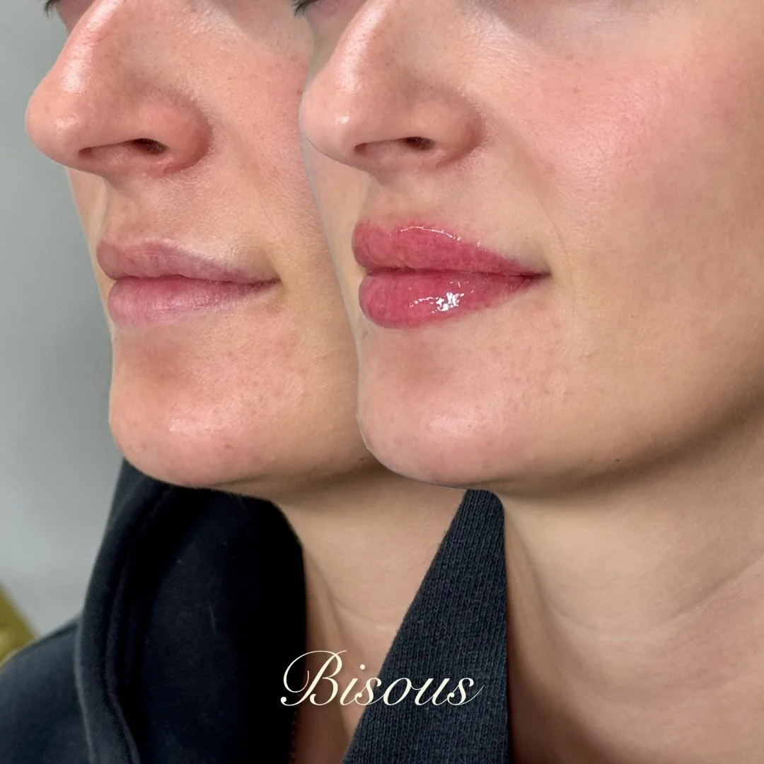 &ldquo;My lip filler never lasts.&rdquo;

Often, it&rsquo;s not about how much is placed, but how it&rsquo;s placed and what product is used.

A multi-layered approach supports the lips from within, helping maintain structure, improve balance, and cr