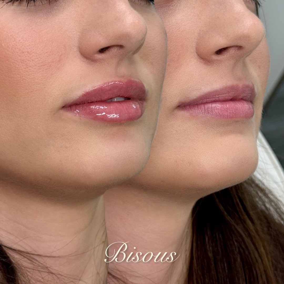 Just enough to make a difference.

Balanced, natural-looking lips that feel aligned with your features&mdash;never overdone.

Booking link in bio💋