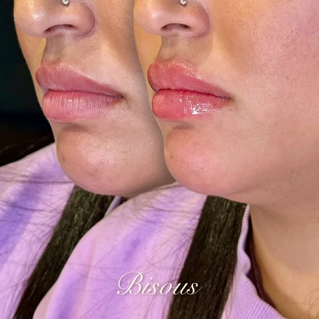 Hydrated and balanced for a natural looking, refreshed look. The Bisous signature 👄

Book your consultation today to get the lips of your dreams! Booking link in bio📲 

#ottawalipfiller #lipfiller #naturalresults #naturallipfiller #ottawa