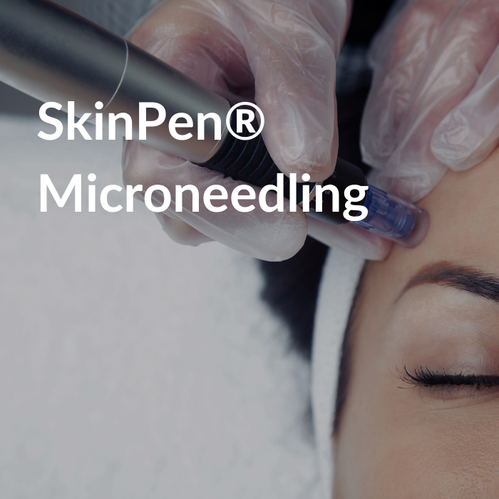 a photo showing a woman receiving a microneedling treatment, zoomed in so you can only see a corner of her