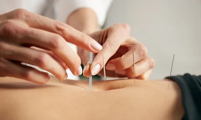 What Changed My Mind About Acupuncture?