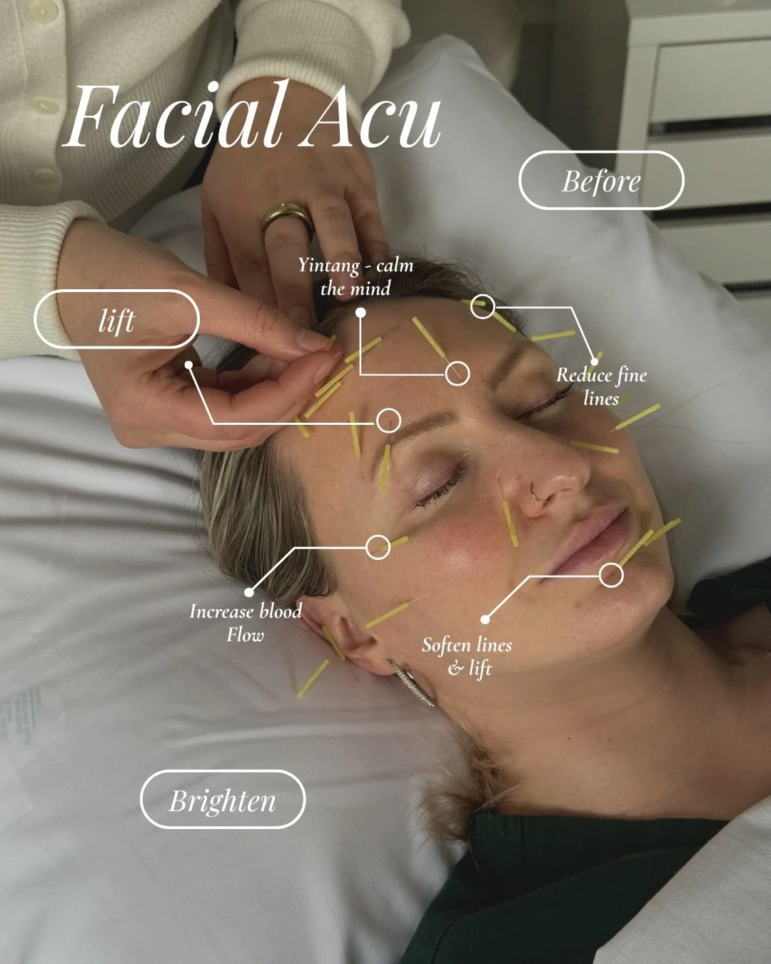 A natural way to lift, brighten, and support healthy, glowing and lifted skin ✨ 

By improving circulation and relaxing facial tension, this treatment helps soften fine lines while promoting a calm mind and radiant glow.

Treatment includes facial ac