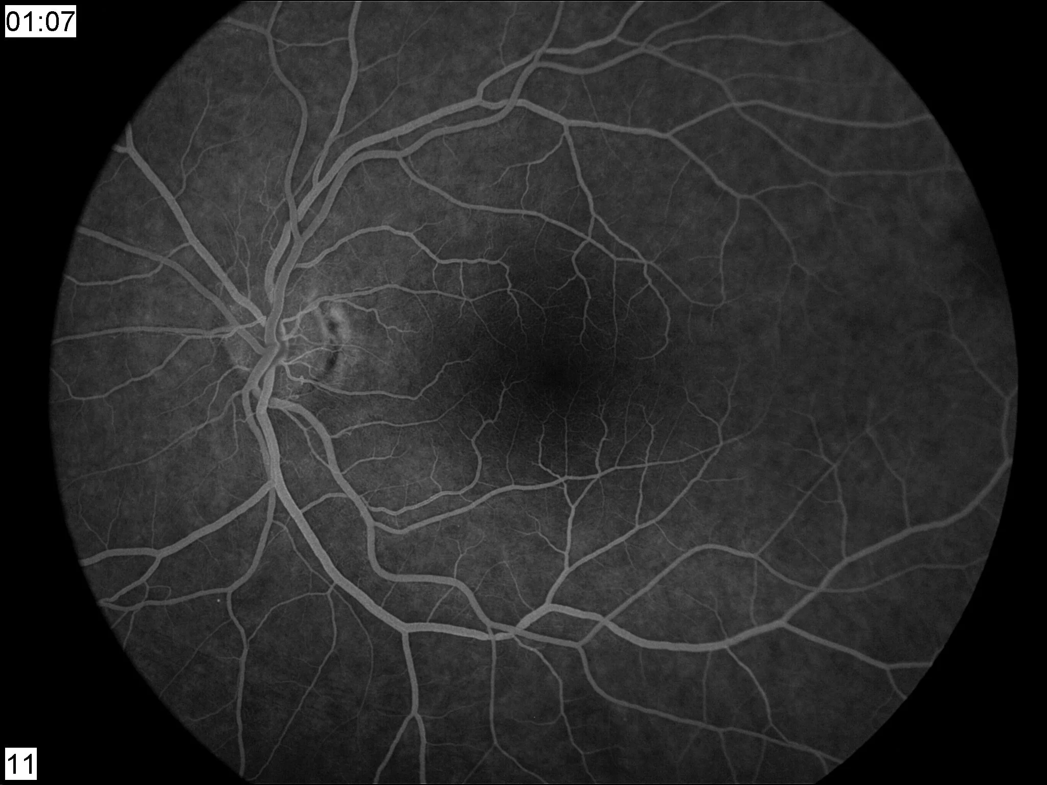 A grayscale medical imaging scan of a human retina showing blood vessels and the optic nerve head.
