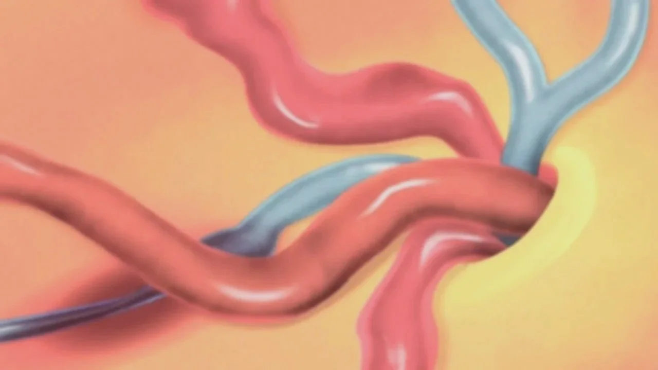 A medical illustration of blood vessels in the brain, including arteries and veins.