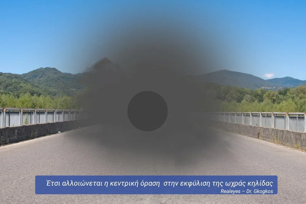 Κεντρική όραση στην εκφύλιση ωχράς κηλίδας – πώς βλέπει ο ασθενής με μαύρη κηλίδα στο κέντρο της εικόνας