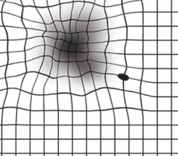 Τεστ Amsler για εκφύλιση ωχράς κηλίδας – παραμόρφωση γραμμών και κεντρικό σκότωμα