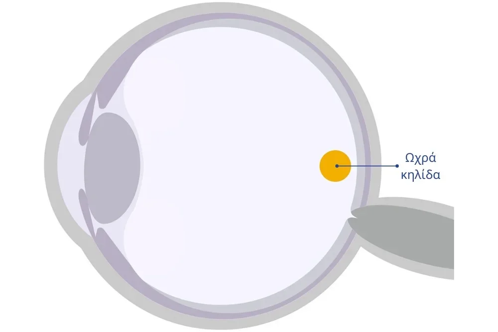 Θέση της ωχράς κηλίδας στον αμφιβληστροειδή – γιατί επηρεάζεται η κεντρική όραση