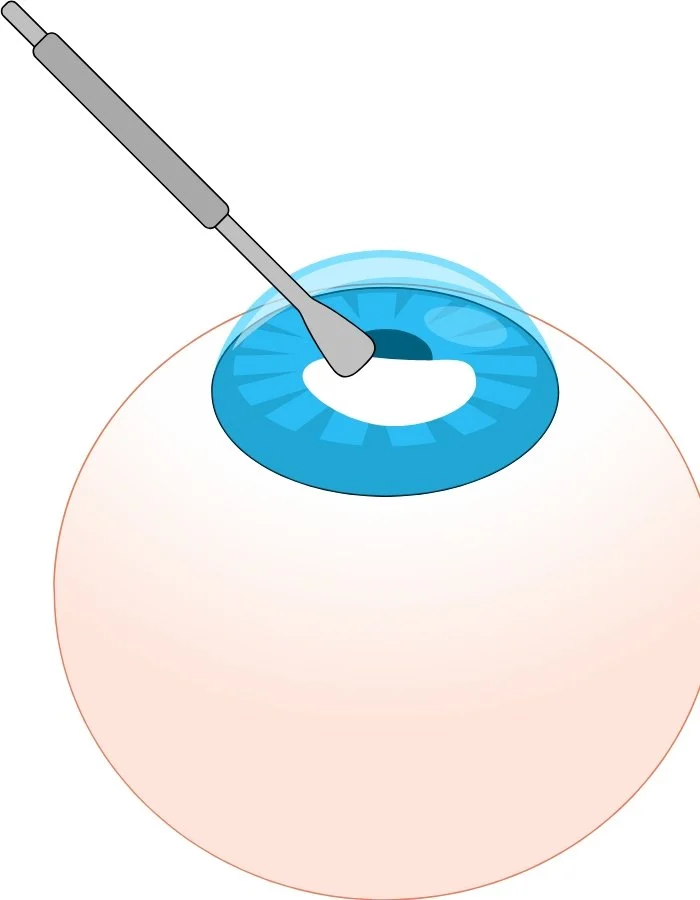 Χειρουργείο καταρράκτη με φακοθρυψία και αφαίρεση θολού φακού