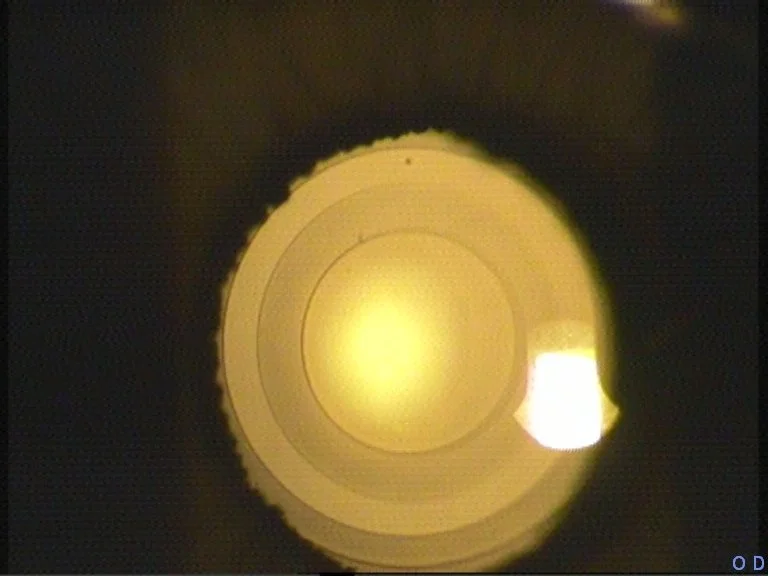 Τεχνητός ενδοφακός για χειρουργείο καταρράκτη