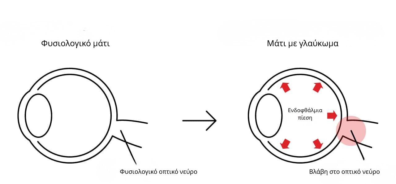Diagram comparing a normal eye with an eye affected by glaucoma, showing increased intraocular pressure impacting the optic nerve.