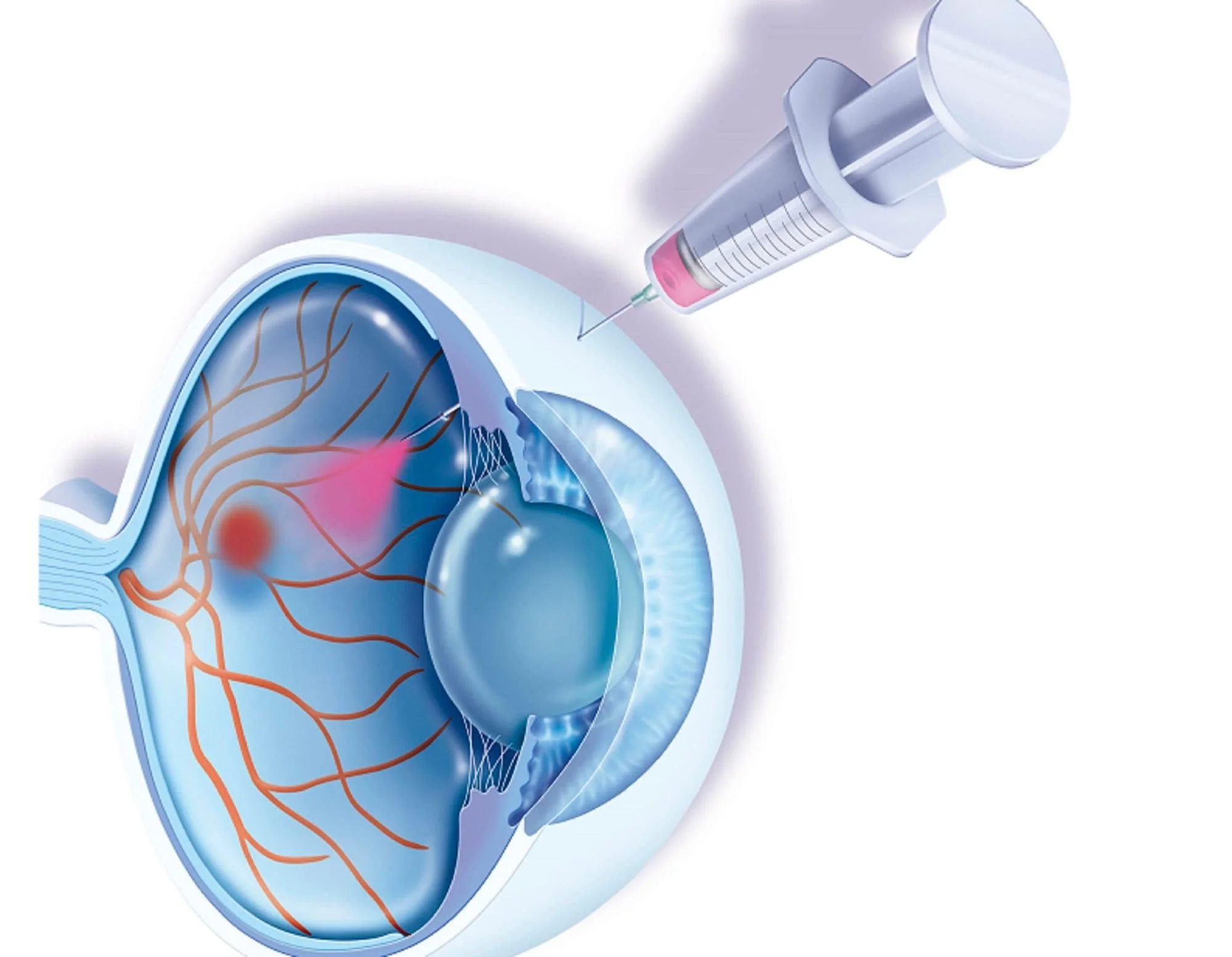 Πώς γίνεται η ενδοϋαλοειδική ένεση στο μάτι βήμα προς βήμα – ανώδυνη διαδικασία anti-VEGF για παθήσεις ωχράς κηλίδας