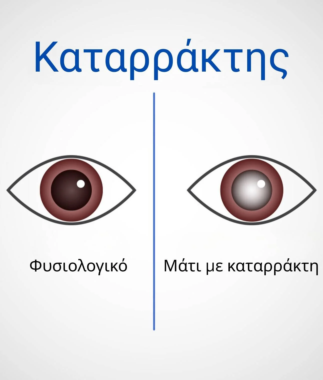 Σύγκριση φυσιολογικού ματιού και ματιού με καταρράκτη
