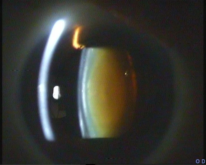 Πυρηνικός καταρράκτης σε εξέταση με σχισμοειδή λυχνία