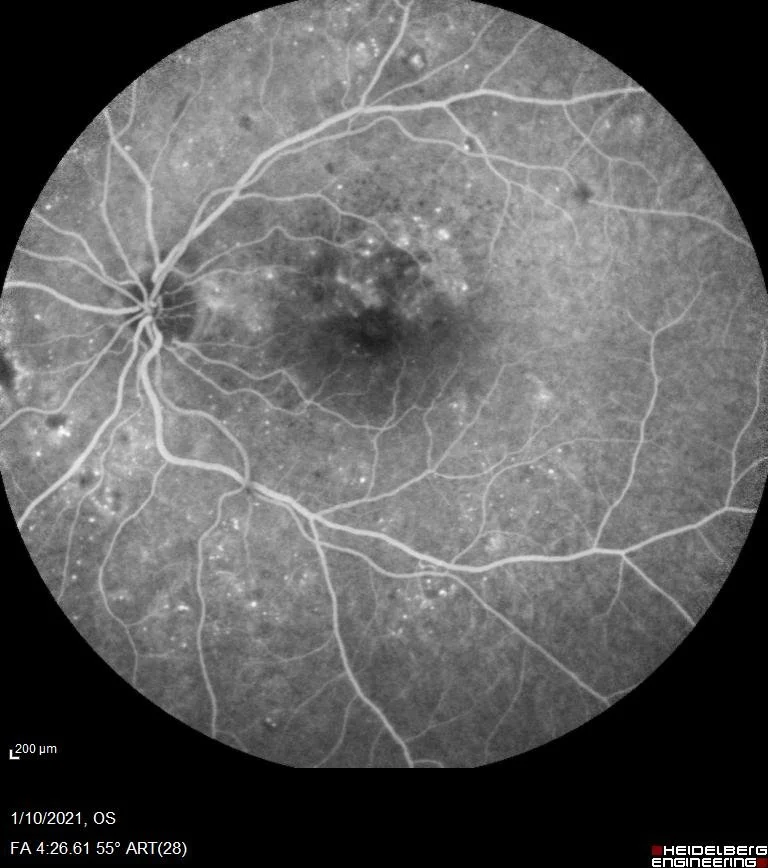 Αγγειογραφία βυθού με μικροανευρύσματα και διαρροές σε μη παραγωγική διαβητική αμφιβληστροειδοπάθεια.