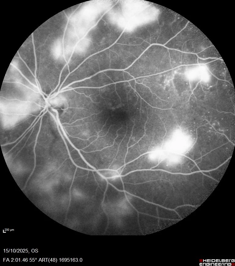 Αγγειογραφία αμφιβληστροειδούς με νεοαγγείωση σε παραγωγική διαβητική αμφιβληστροειδοπάθεια.