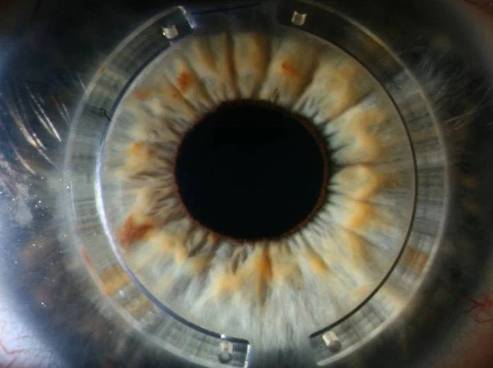 Ενδοκερατοειδικοί δακτύλιοι (ICR – INTACS) τοποθετημένοι στον κερατοειδή για αντιμετώπιση κερατόκωνου