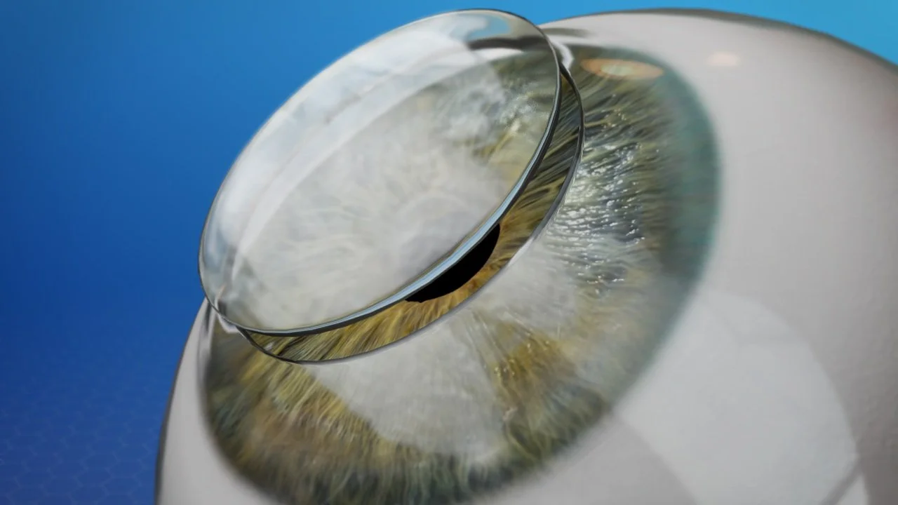 Μεταμόσχευση κερατοειδούς σε προχωρημένο κερατόκωνο – χειρουργική αποκατάσταση της όρασης