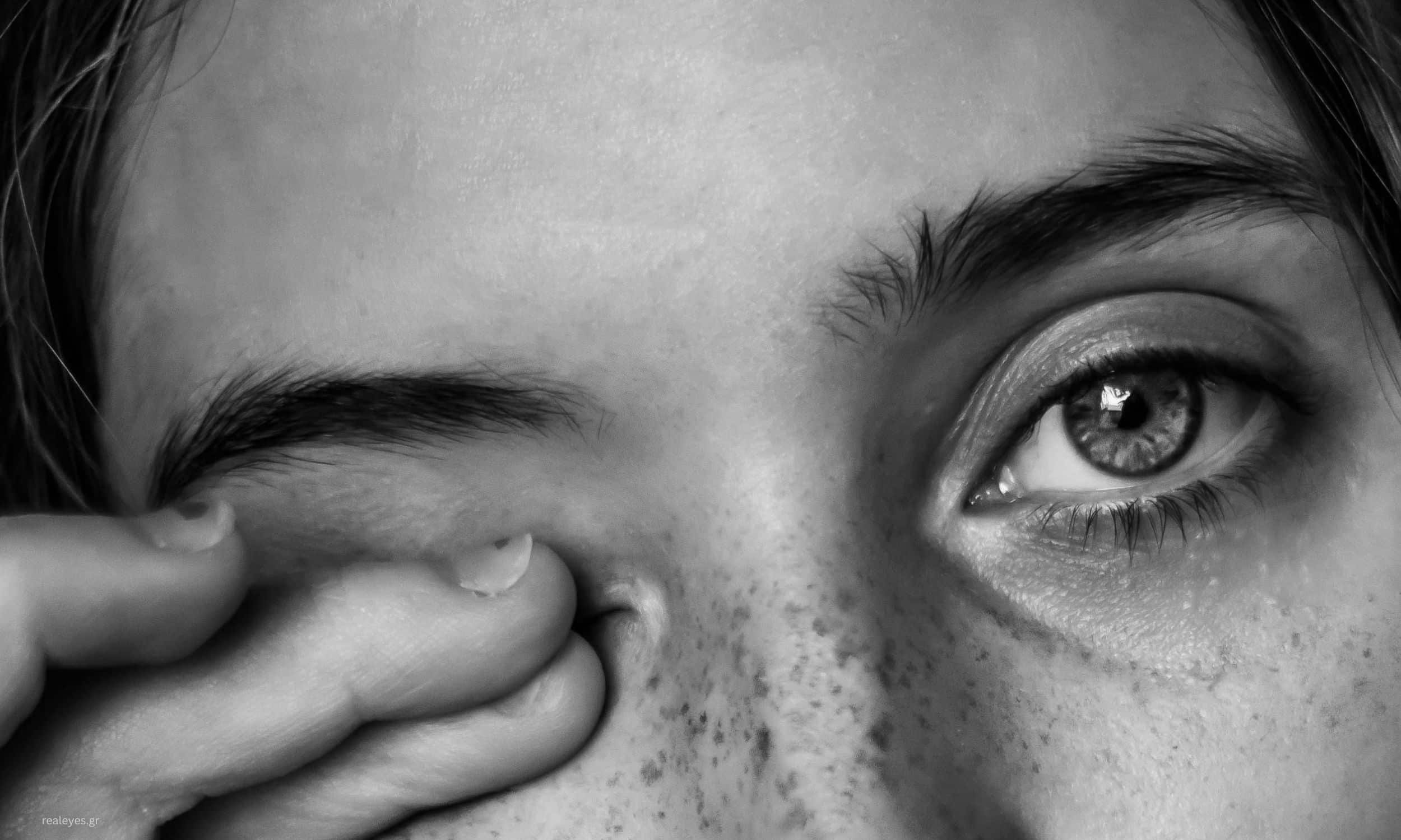 Χρόνιο τρίψιμο των ματιών λόγω αλλεργιών, σημαντικός παράγοντας κινδύνου για την εμφάνιση και εξέλιξη του κερατόκωνου.