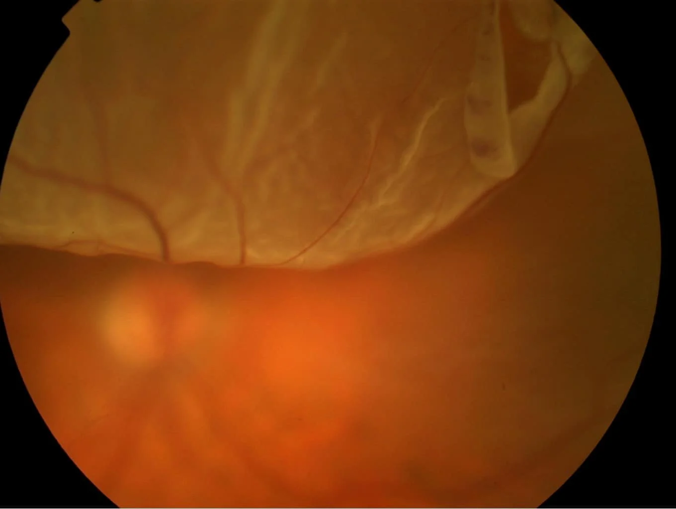 Αποκόλληση αμφιβληστροειδούς σε φωτογραφία βυθού, με ανύψωση και αποκόλληση του νευροαισθητηρίου αμφιβληστροειδούς