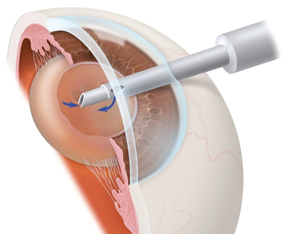 Χειρουργική αφαίρεση καταρράκτη με φακοθρυψία (phacoemulsification)-Dr. Μανώλης Γκόγκος, χειρουργός οφθαλμίατρος στην Αθήνα