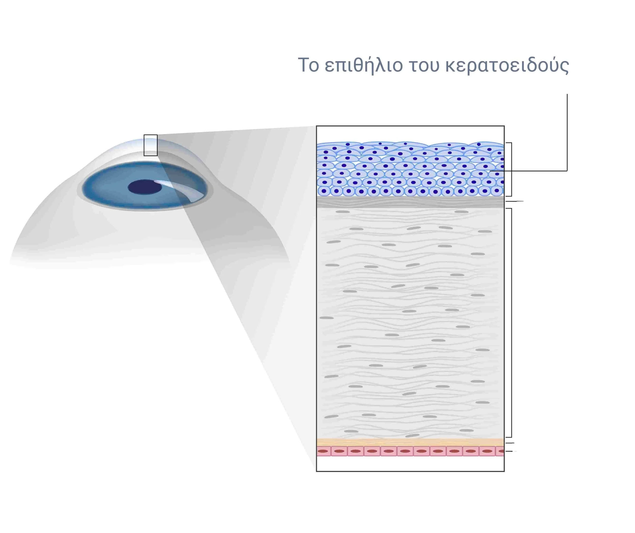 Διάγραμμα που δείχνει τη διαφορά LASIK και PRK στο επιθήλιο του κερατοειδούς
