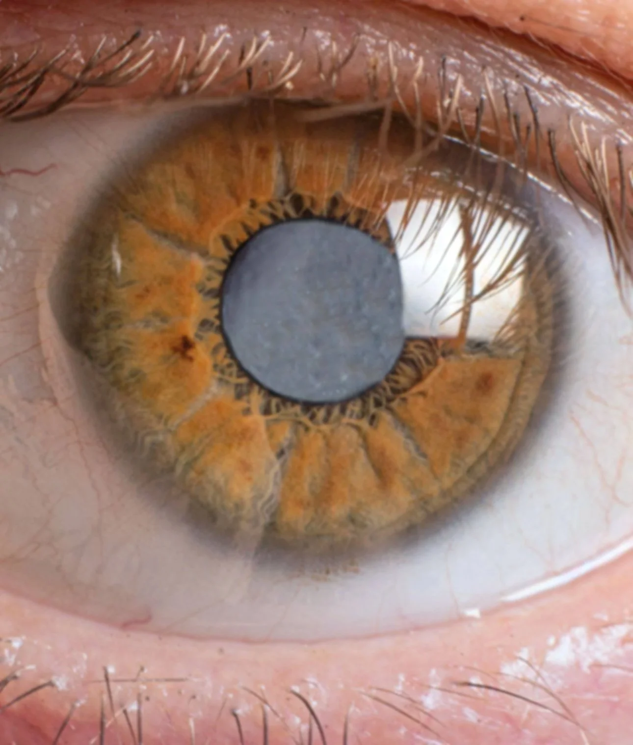Καταρράκτης ματιού με θόλωση του φυσικού φακού