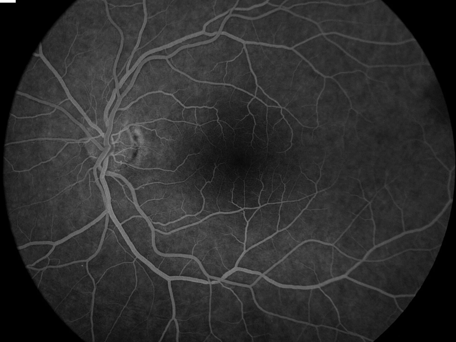 A grayscale image of a human retina showing the optic nerve and branching blood vessels.