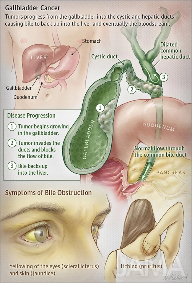 Gallbladder cancer