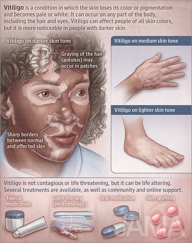 Vitiligo
