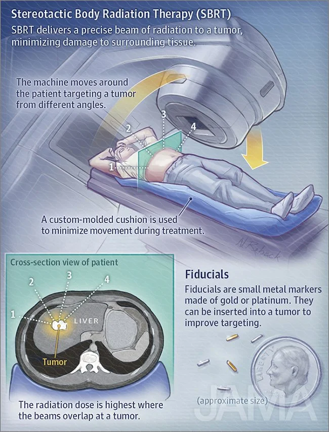 Stereotactic body radiation